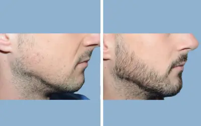 Before and After
